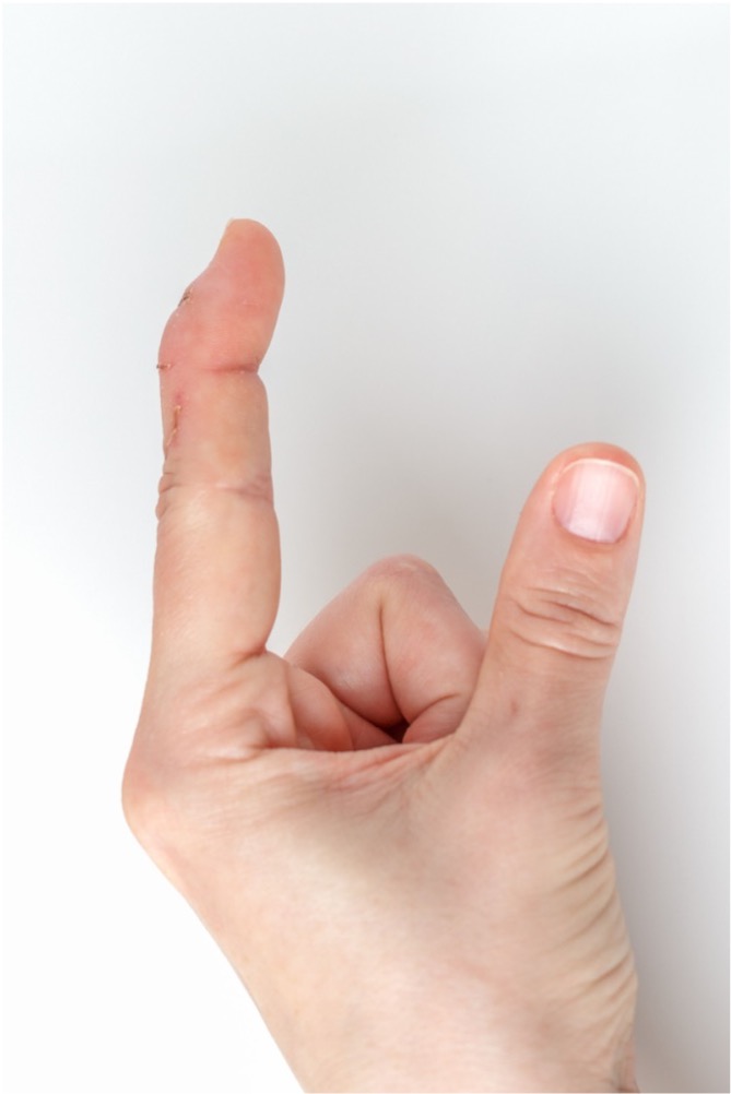 mallet finger 1
