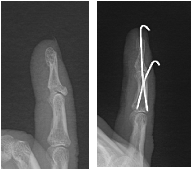 mallet finger 2